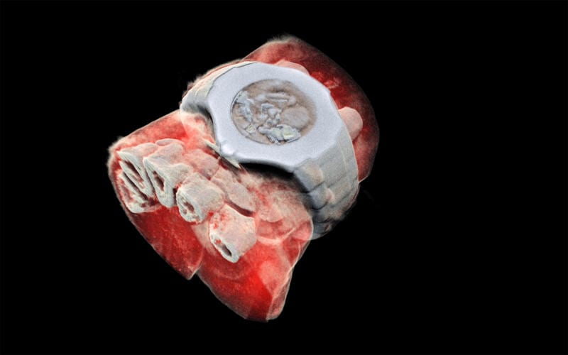 Yeni Zelandalı bir şirket dünyada ilk defa insan vücudunun 3D renkli röntgen görüntüsünü çekti. CERN’in geliştirdiği Medipix3 teknolojisini kullanan cihaz, parçacık izleme teknolojisiyle yüksek çözünürlüklü görüntü elde etmeyi başardı. - yq xray 12072018